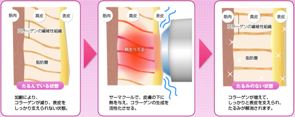 サーマクールなぜたるみが改善する？