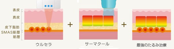 サーマクールとウルセラ