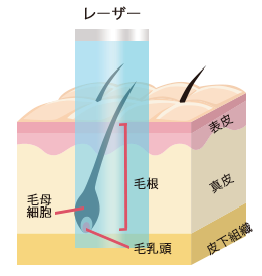 医療レーザー脱毛