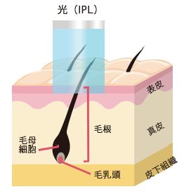 エステ光脱毛