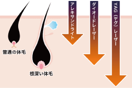 ダイオードレーザー