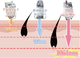 YAGレーザー