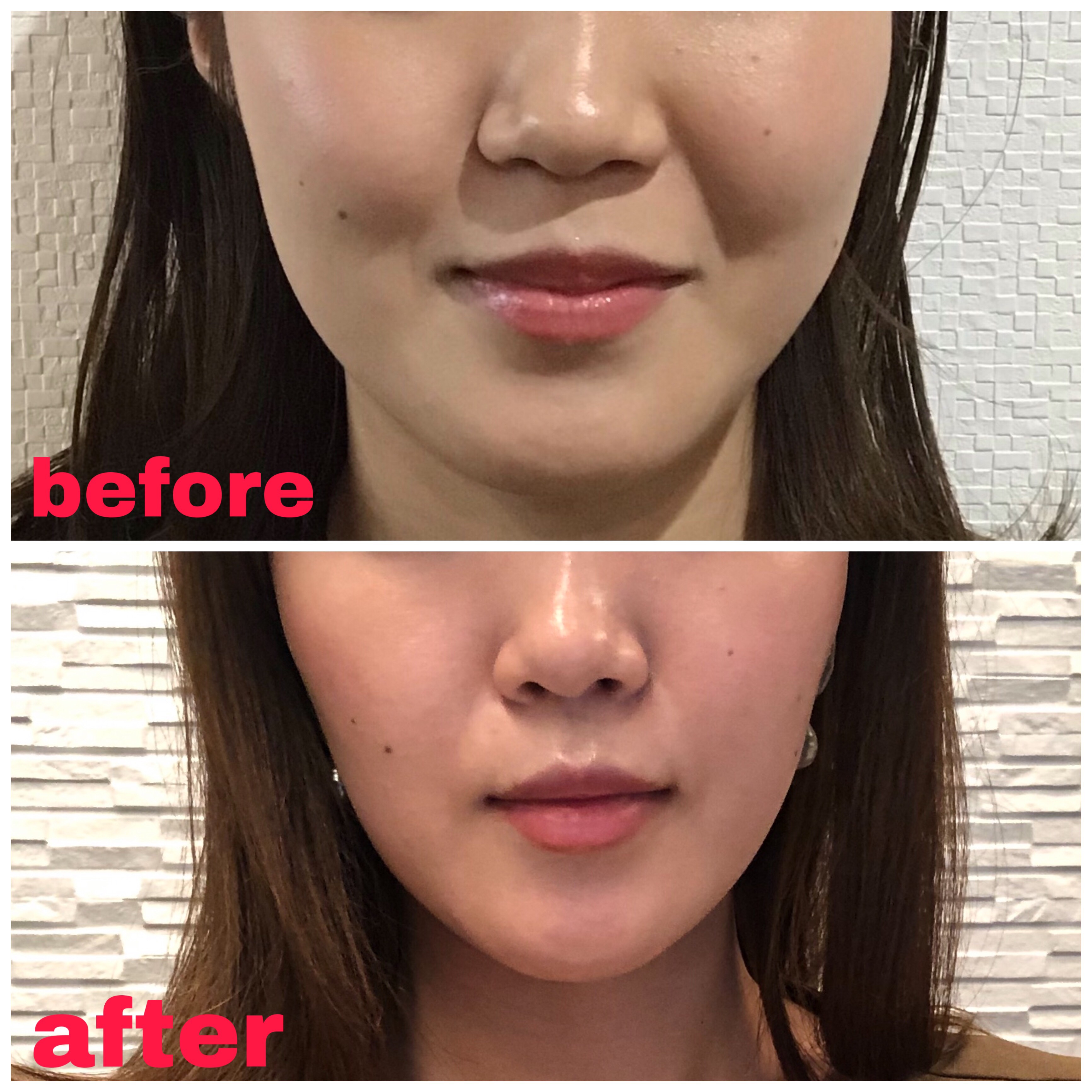 エラボトックス症例写真 Lala Clinic ララクリニック エラボトックス症例写真 Lala Clinic ララクリニック